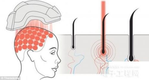頭盔是前美國航空航天局的科學家Tamim哈米德發(fā)明的，他是theradome創(chuàng)始人兼首席執(zhí)行官。